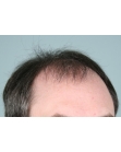 Before Hair Transplant&nbsp;2 Sessions (Areas)